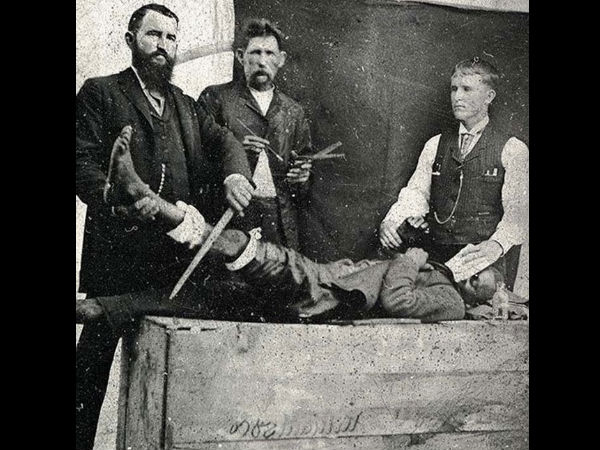 அறுவை சிகிச்சை முறை - 1885