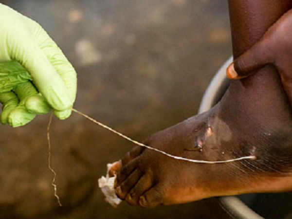 ராஜஸ்தான் மக்களுக்கு ஏற்பட்ட வினோத புழு தாக்கம்