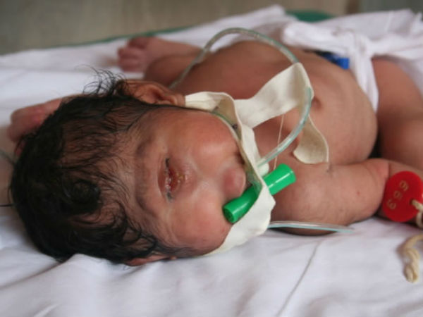  ஒற்றை கண்ணுடன் பிறந்த குழந்தை 