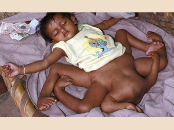 நான்கு கை, கால்களுடன் பிறந்த குழந்தை