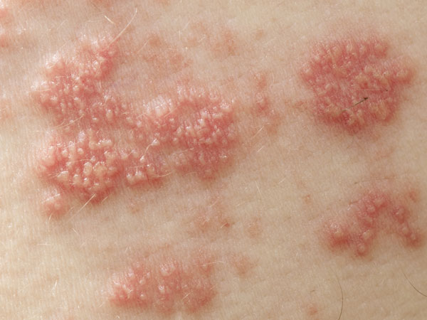 படை நோய் (Hives)