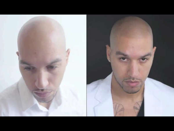 உச்சந்தலையில் நிறமூட்டல் (Scalp Pigmentation) உச்சந்தலையில் நிறமூட்டல் (Scalp Pigmentation)