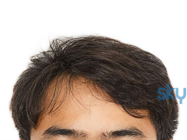 முடி வளர்ச்சி முடி வளர்ச்சி