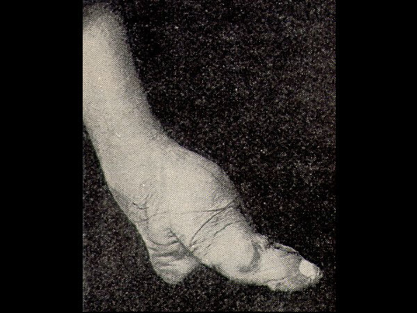 சீனர்களின் கால் பிணைப்பு (Chinese Foot Binding) 