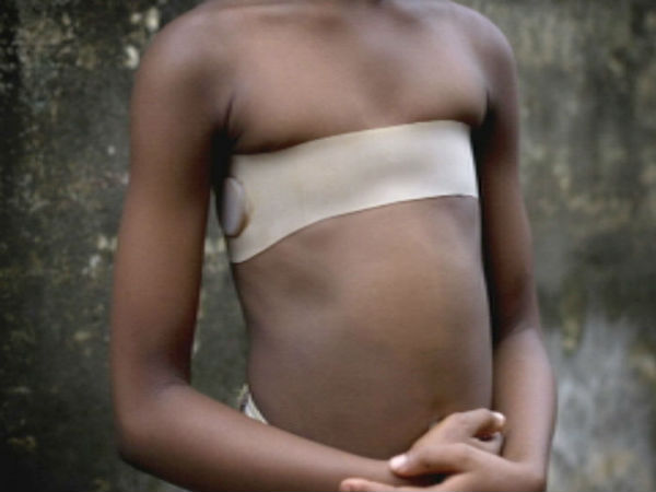 காமரூன் மார்பக மாற்றமைப்பு (Cameroonian Breast Ironing) 