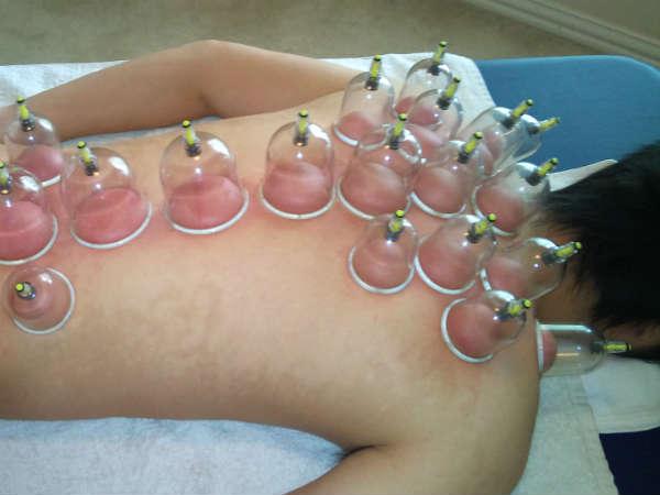 குப்பிங் தெரபி 