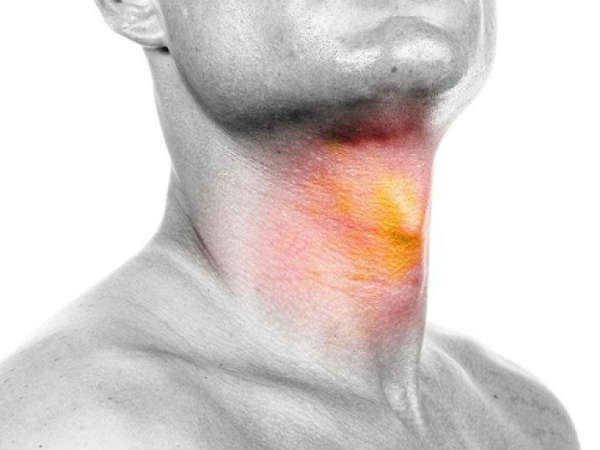 தொண்டையில் எரிச்சல்