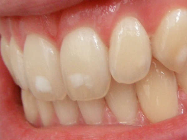 பற்களில் சிவப்பு அல்லது வெள்ளை புள்ளிகள்