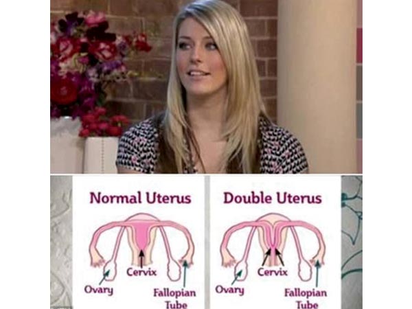 2 பிறப்புறுக்களுடன் பெண்