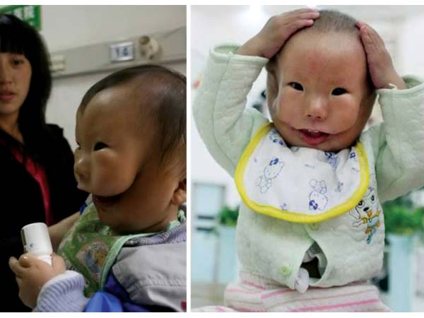 இரு முகங்களுடன் குழந்தை