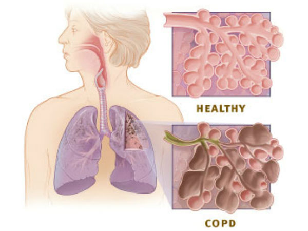 நாள்பட்ட நுரையீரல் அடைப்பு நோய்