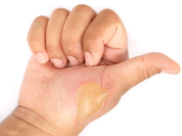 தீக்காயங்கள்