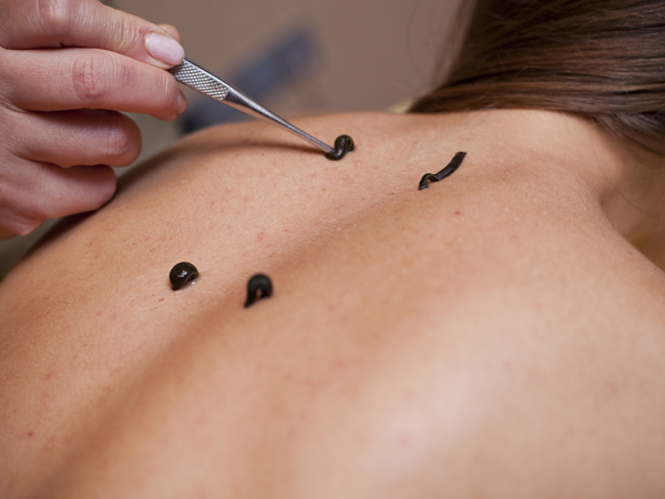 How is leech therapy beneficial ?