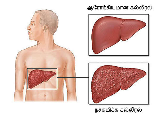 கல்லீரல் சுத்தமாகும் கல்லீரல் சுத்தமாகும்