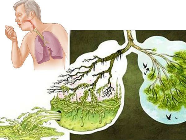 மஞ்சள் அல்லது பச்சை நிற சளி