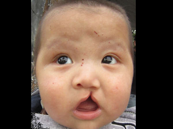 பிளவுபட்ட உதடுகள்