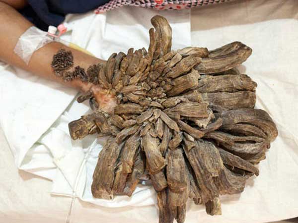 அரிய மரபணு நிலை