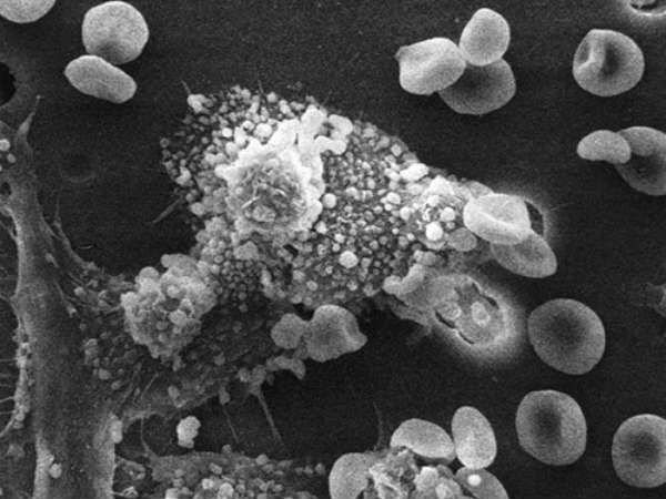 இச்சத்து மார்பக புற்றுநோய் செல்களை அழிக்குமா?