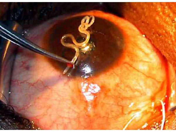 கண்களில் புழு