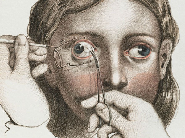 மாறுகண் திருத்தம்!