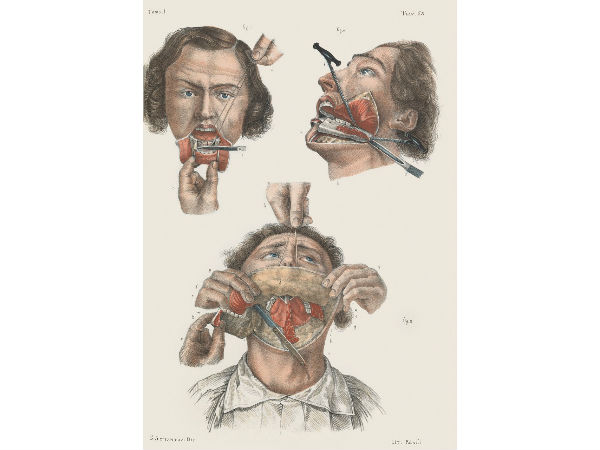 தாடை அகற்றம்!