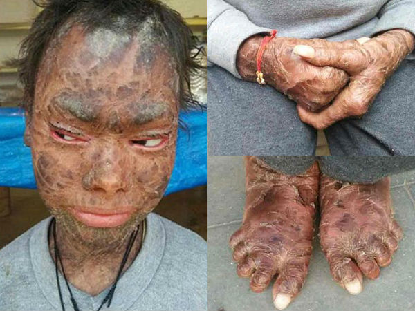 This Girl Sheds Her Skin Every 6 Weeks! This Girl Sheds Her Skin Every 6 Weeks!