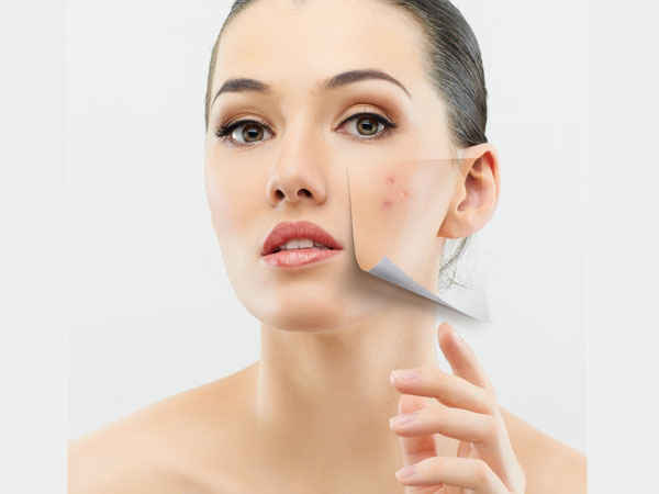 முகப்பருக்கள் முகப்பருக்கள்