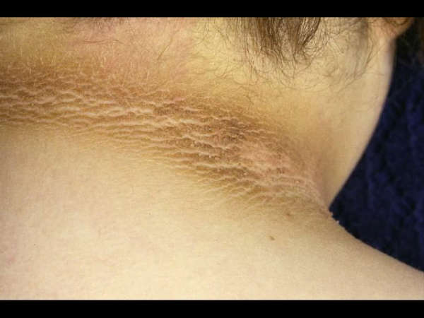 In Just 1 Use Of This Scrub Removes Sun Tan And Dark Marks In Just 1 Use Of This Scrub Removes Sun Tan And Dark Marks