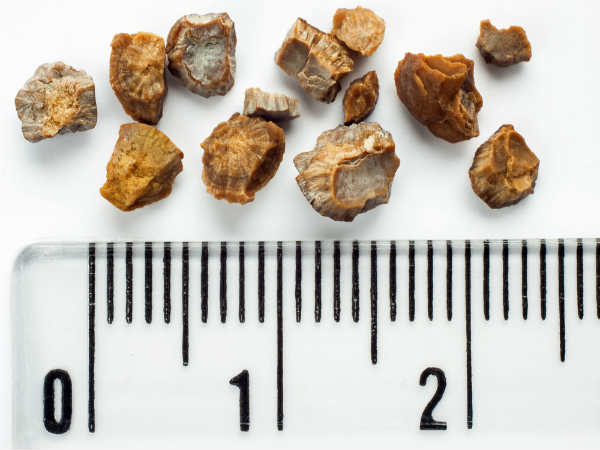Symptoms Of Kidney Stones That You Need To Know, Their Treatment & Natural Remedies 