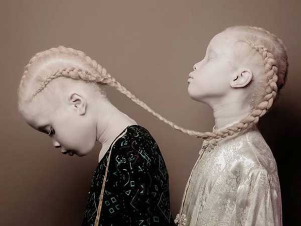 ஆல்பினோ ட்வின்ஸ்!