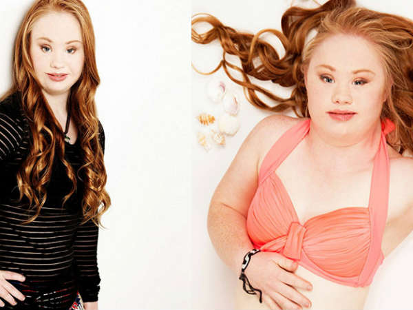 டவுன் சிண்ட்ரோம் : 