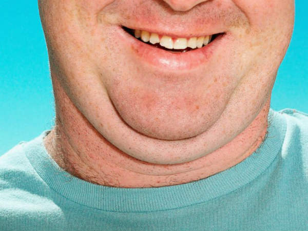 இரட்டை தாடை : 