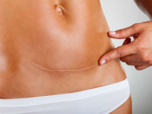 சிசேரியன் : 