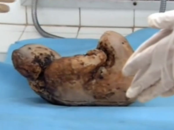 மருத்துவ அதிசயம் : 