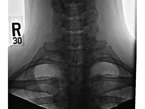 கழுத்து விலா எலும்பு!