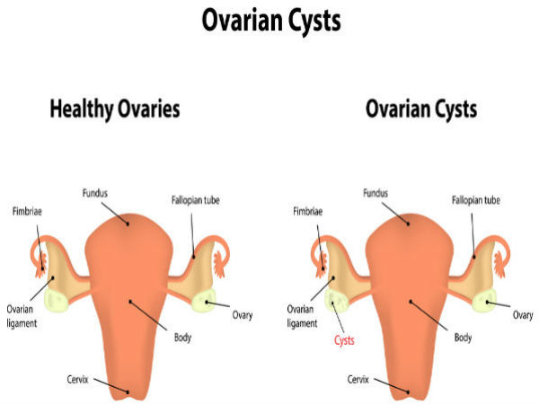 கருப்பை கோளாறுகள் : 