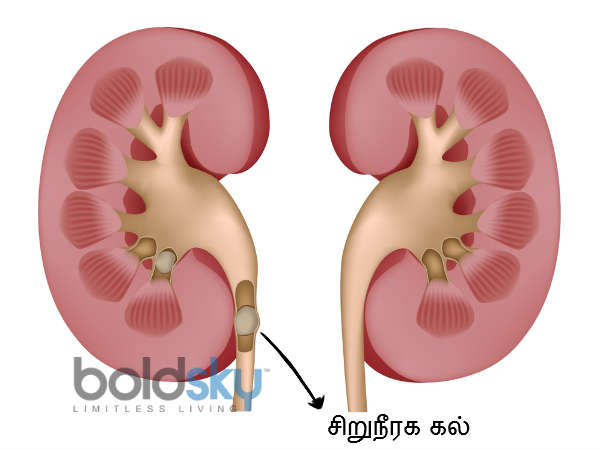 சிறு நீர் கற்களுக்கு :