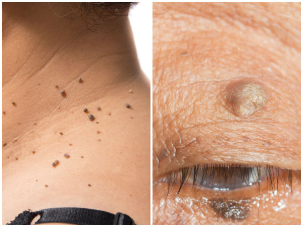 பால் மருவை குணப்படுத்த :