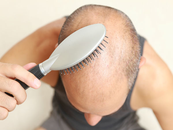 hair transplantation is only permanent solution for baldness
