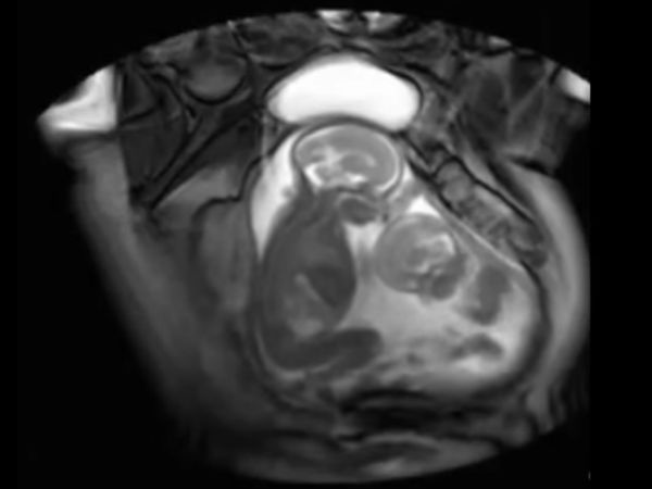 சிசு கர்ப்பம்!