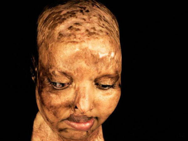  உருகி வழிந்த சதை : 