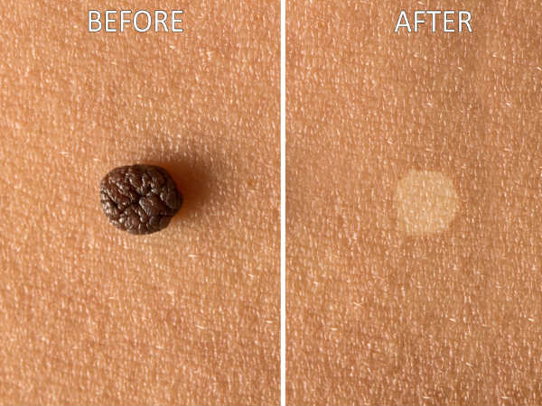 How to remove skin tags naturally 