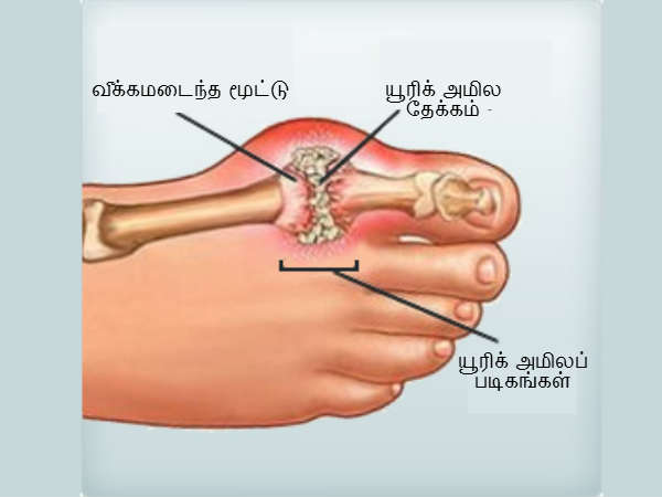  கீல் வாத நோய் யாருக்கு ஏற்படும்?