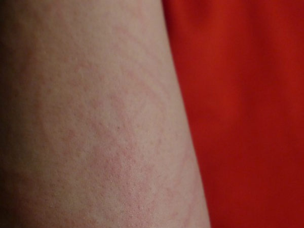 சருமப் பிரச்சனைகள் : 