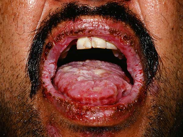 பரனோபிளாஸ்டிக் பெம்பைஸ்