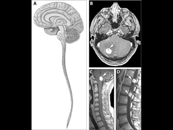 வோன் ஹிப்பல்-லிண்டாவ் நோய் (VHL)