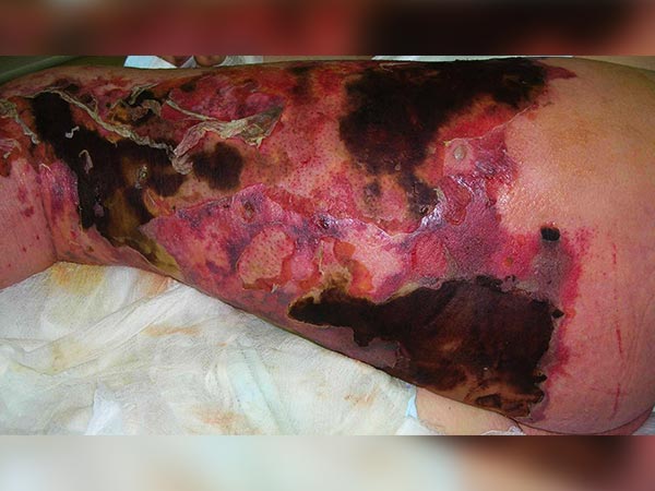 நெக்ரோடைசிங் ஃபாசிடிடிஸ்