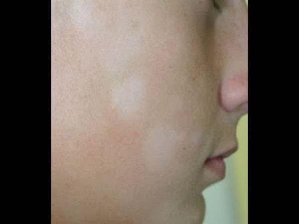 வெண்புள்ளிகள்