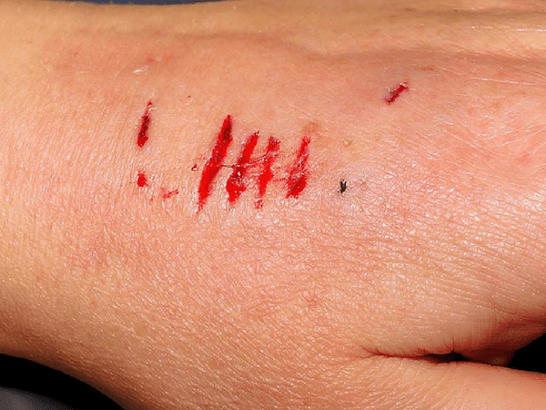 காயங்கள் தாமதமாக குணமாவது