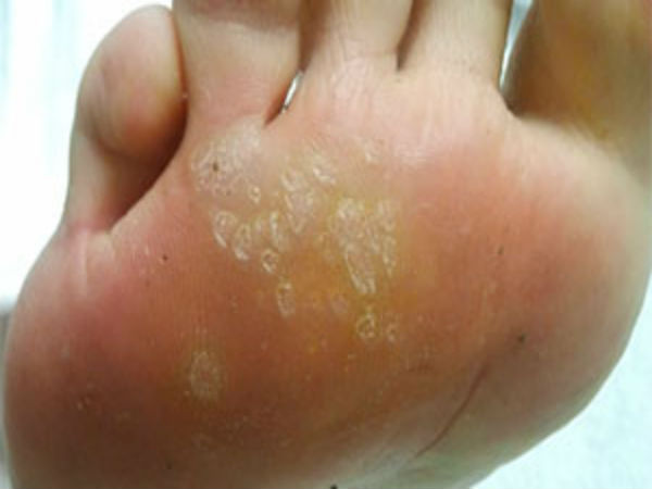 பிளானர் மருக்கள்